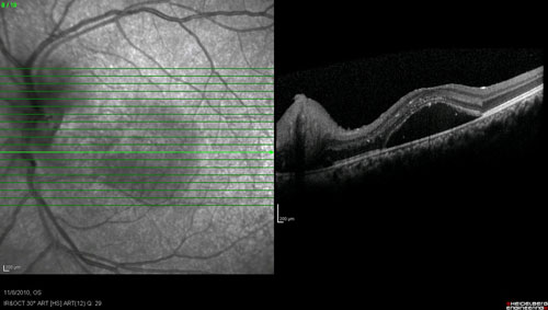 Acute Macular Neuroretinopathy treatment in Fort Myers, Florida