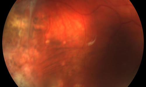 Acute Retinal Necrosis Syndrome treatment in Fort Myers, Florida