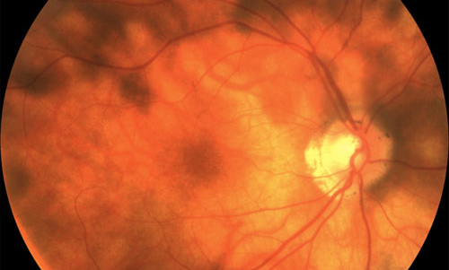 Birdshot Retinopathy treatment in Fort Myers, Florida