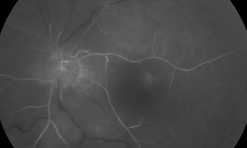 Central Retinal Artery Occlusion treatment in Fort Myers, Florida