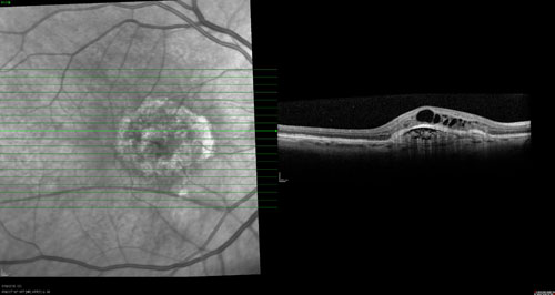 Macular Degeneration treatment in Fort Myers, Florida