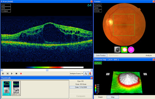 Macular Edema treatment in Fort Myers, Florida