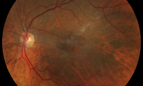 Macular Epiretinal Membrane treatment in Fort Myers, Florida