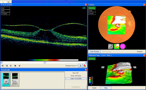 Macular Traction treatment in Fort Myers, Florida