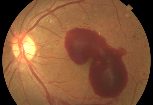 Non Proliferative Retinopathy treatment in Fort Myers, Florida