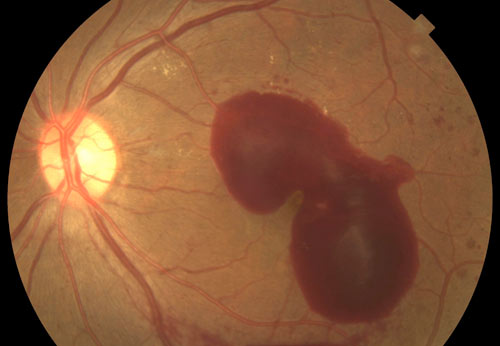 Proliferative Retinopathy treatment in Fort Myers, Florida