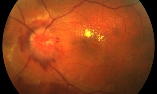 Radiation Retinopathy treatment in Fort Myers, Florida
