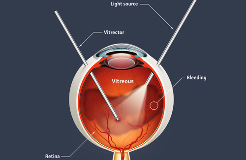 Retina treatment in Fort Myers, Florida