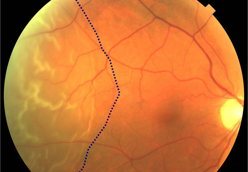 Retinal Detachment treatment in Fort Myers, Florida