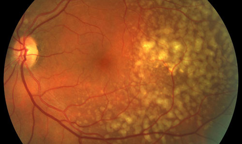 Retinal Dystrophy treatment in Fort Myers, Florida