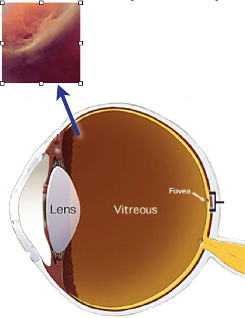 Retinal Hole treatment in Fort Myers, Florida