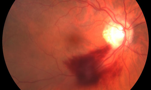 Retinal Hypertension treatment in Fort Myers, Florida