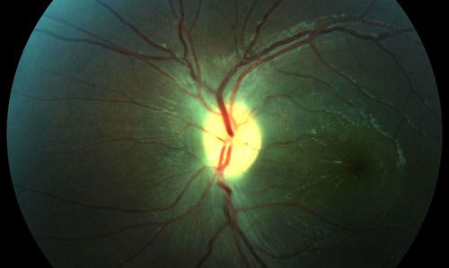 Retinal Infections treatment in Fort Myers, Florida