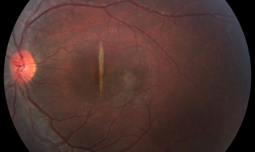 Retinal Inflammation treatment in Fort Myers, Florida