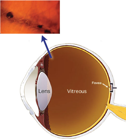 Retinal Lattice Degeneration treatment in Fort Myers, Florida