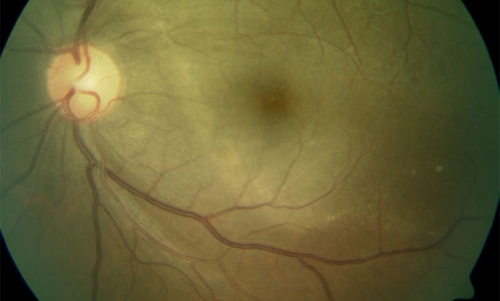 Retinal Syphilis and Tuberculosis treatment in Fort Myers, Florida