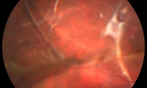 Retinal Trauma treatment in Fort Myers, Florida