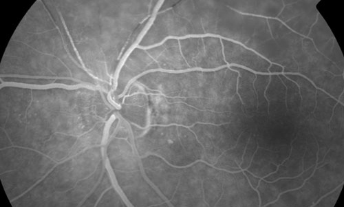 Retinal Vasculopathy treatment in Fort Myers, Florida