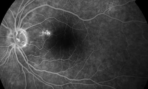 Serous Detachment of Retina treatment in Fort Myers, Florida