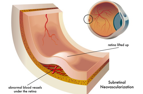 Retina treatment in Fort Myers, Florida