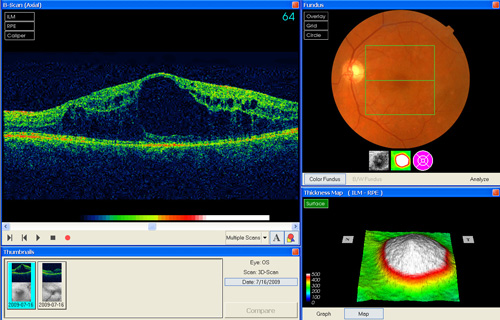 Macular Edema treatment in Bonita Springs FL