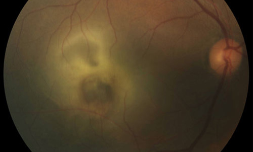 Retinal Syphilis and Tuberculosis
 treatment in Bonita Springs FL