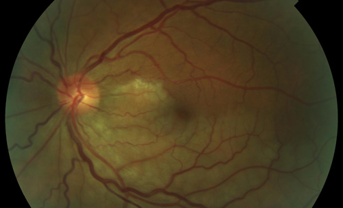 Branch Retinal Artery Occlusion treatment in Naples, Florida