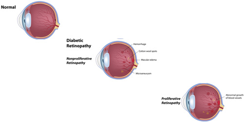 Diabetic Retinopathy treatment in Naples, Florida