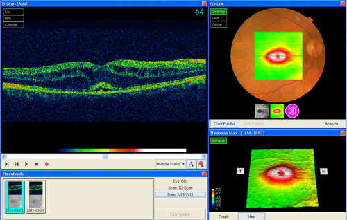 Macular Cystoid Macular Edema treatment in Naples, Florida