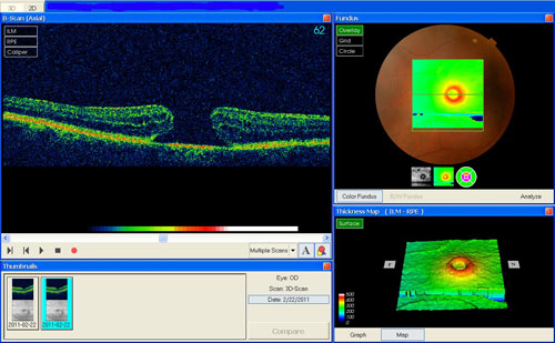 Macular Hole treatment in Naples, Florida