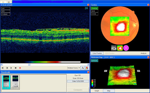 Macular Pucker treatment in Naples, Florida