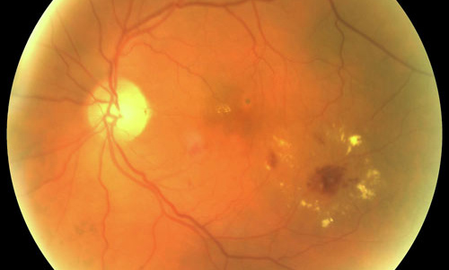 Retinal Microaneurysm treatment in Naples, Florida