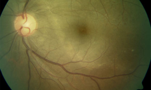 Retinal Syphilis and Tuberculosis treatment in Naples, Florida