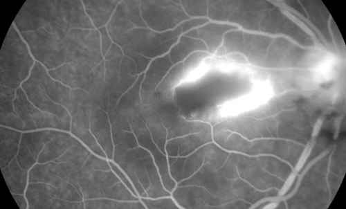Retinal Toxoplasmosis treatment in Naples, Florida