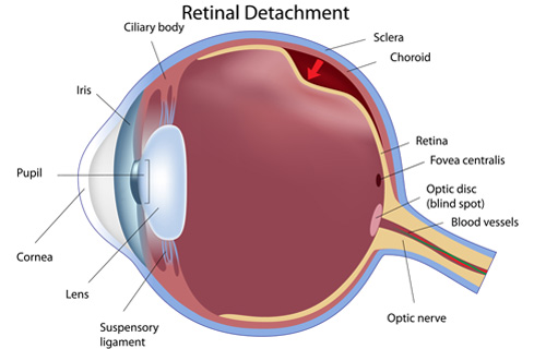 Retina treatment in Naples, Florida